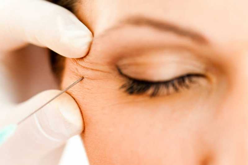 Aplicação de Botox no Rosto Clínica Vila Universal - Aplicação de Botox na Testa
