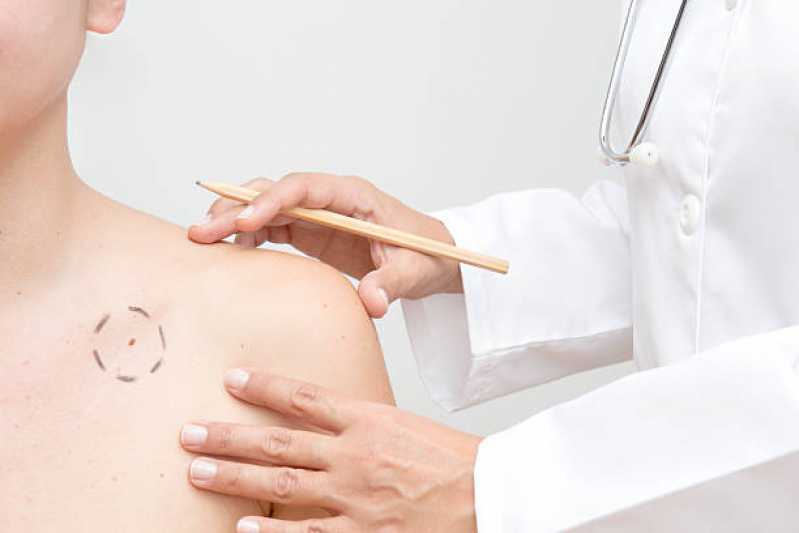 Biópsia para Câncer de Pele Conjunto Habitacional Mirante dos Altos - Biópsia de Pele para Dermatite