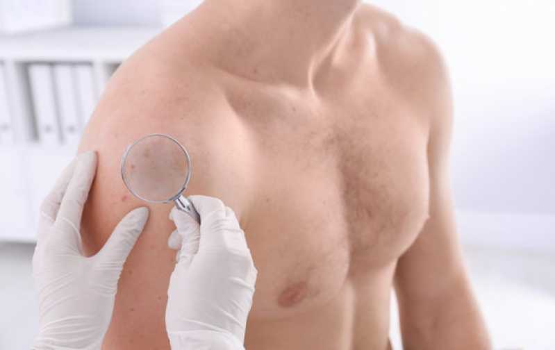 Biópsia Pele Quatro Encruzilhadas - Biópsia de Pele para Dermatite