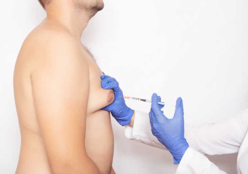Cirurgia de Ginecomastia Bilateral Marcar Vila Áurea - Cirurgia de Ginecomastia para Homens