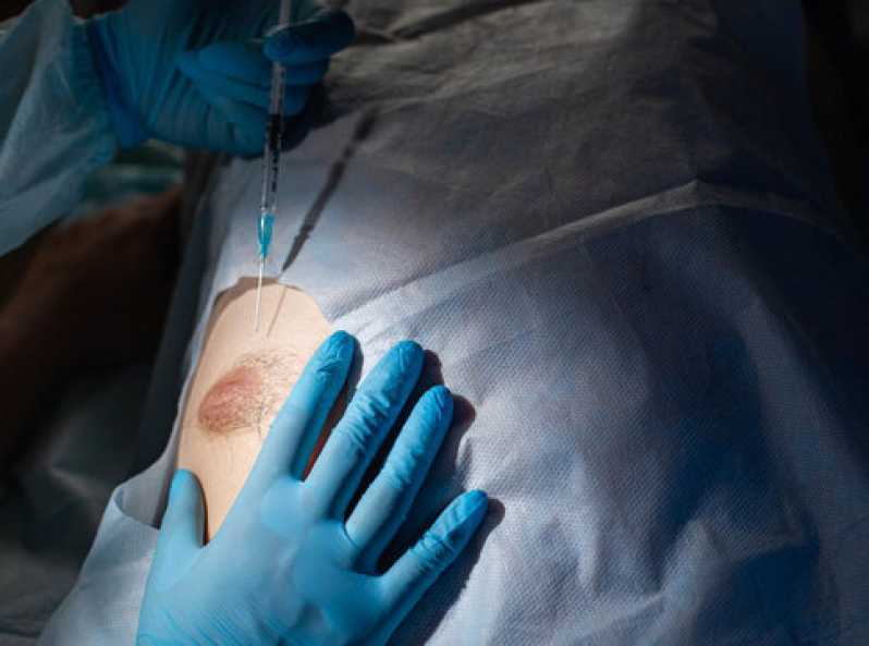 Cirurgia de Ginecomastia Homem Marcar Condomínio Refúgio Pinheiros - Operação de Ginecomastia