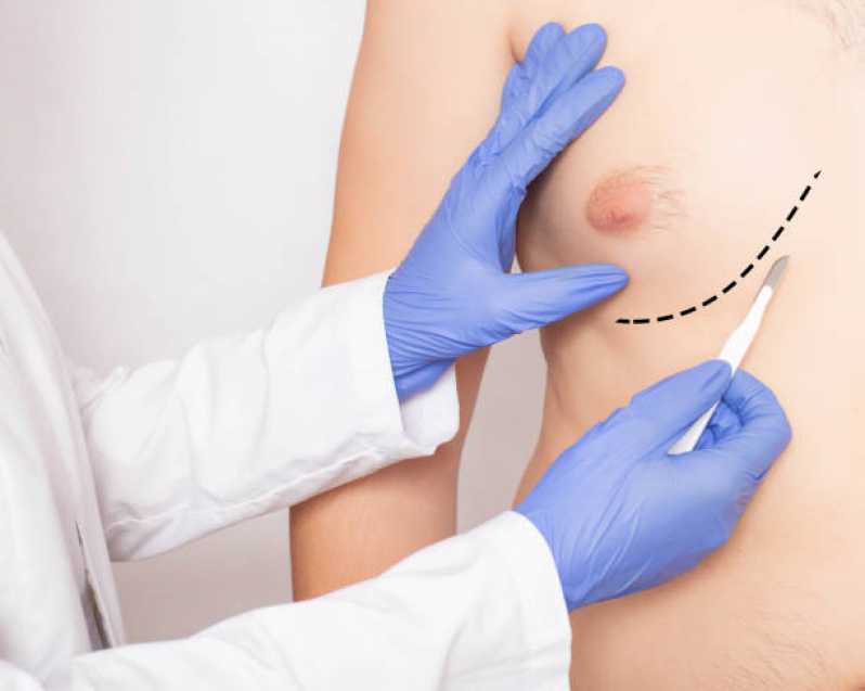 Cirurgia de Ginecomastia Masculina Agendar Vila Menck - Cirurgia Plástica Ginecomastia para Homens