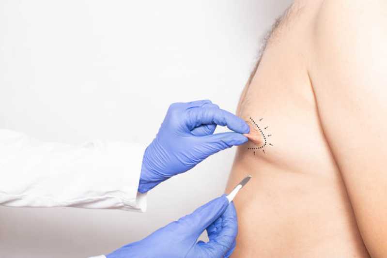 Cirurgia de Ginecomastia para Homem Marcar Terras do Madeira - Cirurgia de Ginecomastia para Homens