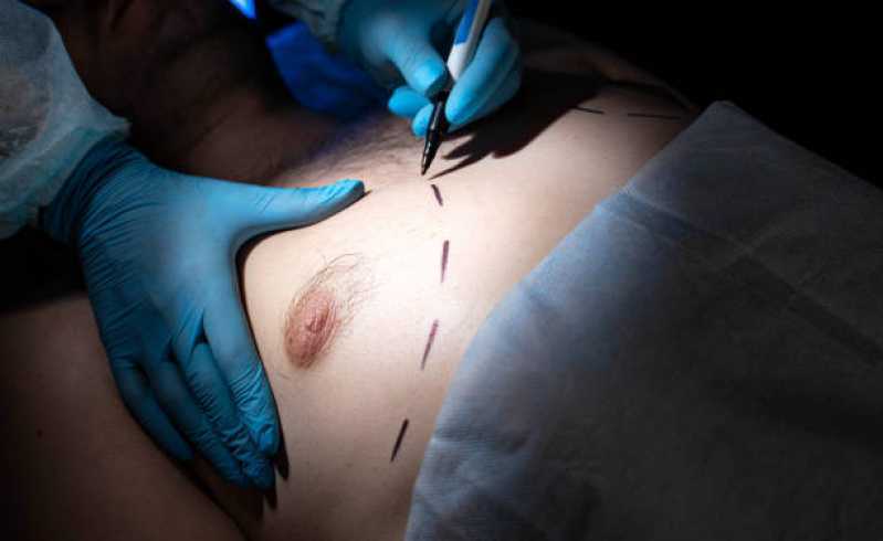 Cirurgia de Ginecomastia para Homens Marcar Alphaville Condomínio I - Cirurgia para Ginecomastia