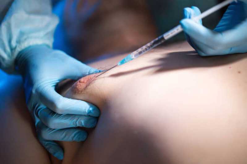 Cirurgia de Ginecomastia para Homens Chácara do Refúgio - Cirurgia para Ginecomastia