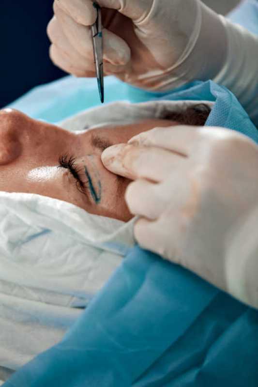 Cirurgia Pálpebra Jardim das Margaridas - Cirurgia de Blefaroplastia
