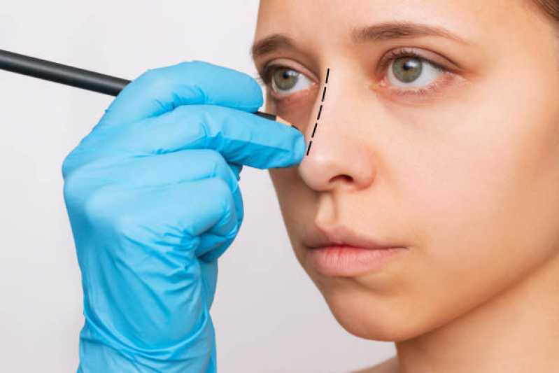 Cirurgia para Afinar o Nariz Presidente Altino - Cirurgia para Correção da Estética Nasal