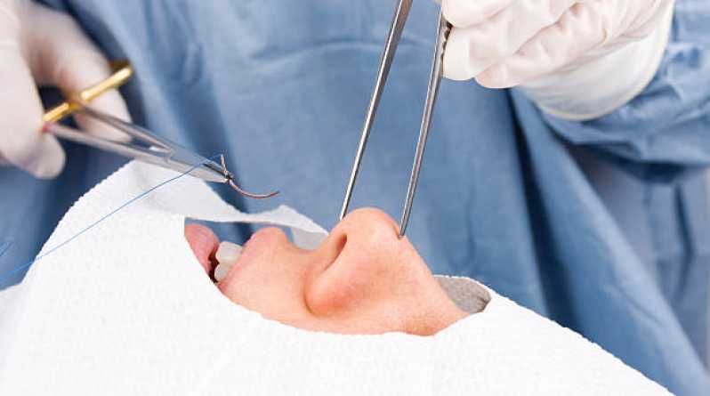 Cirurgia para Diminuir o Nariz Vila Osmany - Cirurgia Rinoseptoplastia