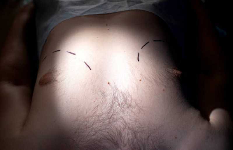 Cirurgia para Ginecomastia Marcar Tijoleiros - Cirurgia Plástica Ginecomastia para Homens