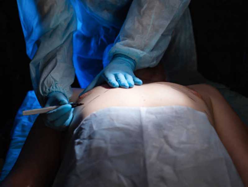 Cirurgia para Ginecomastia Águas da Fazendinha - Cirurgia Plástica Ginecomastia para Homens