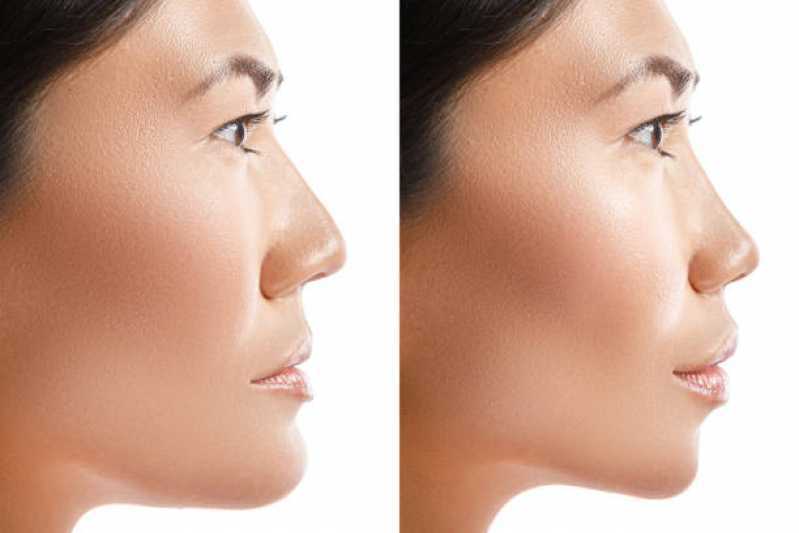Cirurgia para Remodelar o Nariz Vila Menk - Cirurgia para Correção da Estética Nasal
