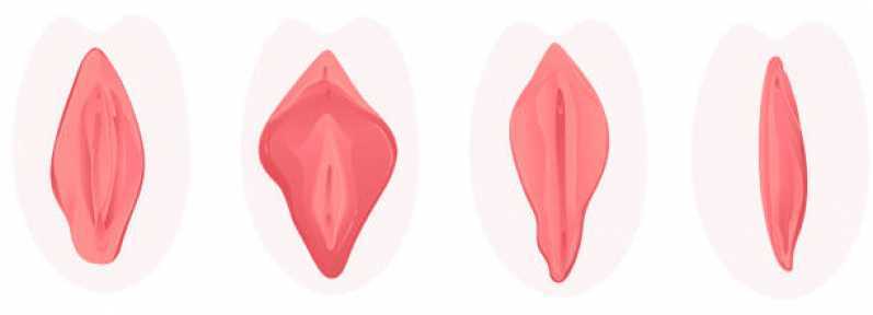 Cirurgia Pequenos Lábios Quatro Encruzilhadas - Cirurgia dos Grandes Lábios