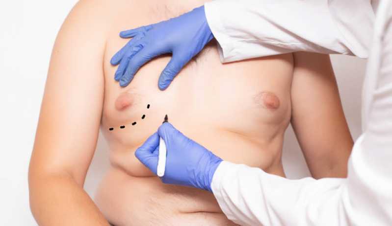 Cirurgia Plástica Ginecomastia para Homens Tijoleiros - Cirurgia de Ginecomastia Masculina