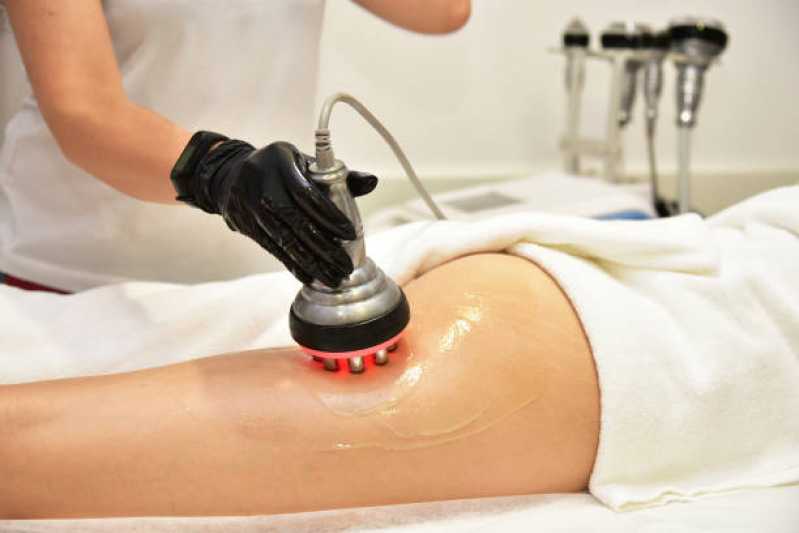 Clínica Especialista em Tratamento Celulite Grau 3 Conjunto Habitacional - Setor B - Tratamento para Celulite nas Pernas