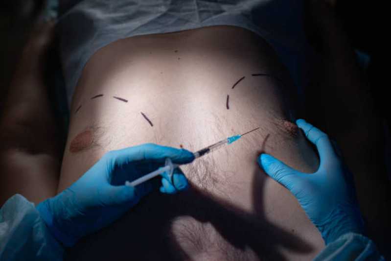 Clínica Especializada em Cirurgia Ginecomastia Alphaville Centro Apoio I - Cirurgia Plástica Ginecomastia para Homens