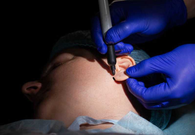 Clínica Que Faz Cirurgia de Orelha Rasgada Parque Mira Flores - Cirurgia Lobuloplastia