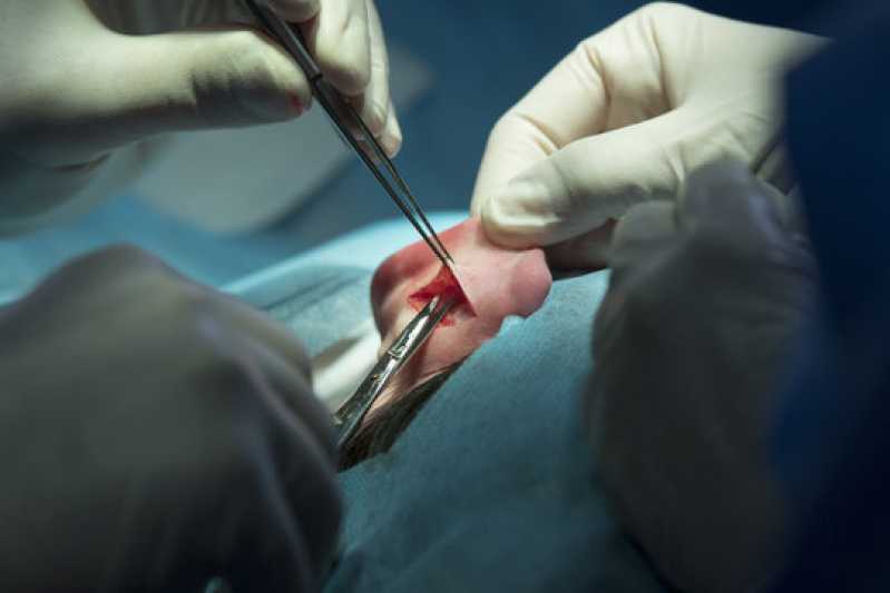 Clínica Que Faz Cirurgia Otoplastia Vila Sol - Cirurgia de Lobuloplastia