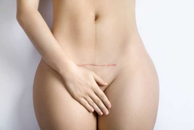 Clínica Que Faz Correção Cicatriz Abdominoplastia Metalúrgicos - Correção de Cicatriz de Abdominoplastia