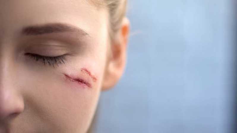 Clínica Que Faz Correção de Cicatriz de Abdominoplastia Mutinga - Correção de Cicatriz no Rosto