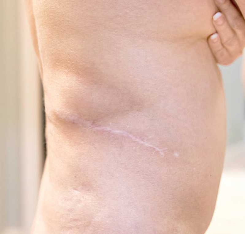 Clínica Que Faz Correção de Cicatriz de Mama Centro Comercial - Correção de Cicatriz de Mama