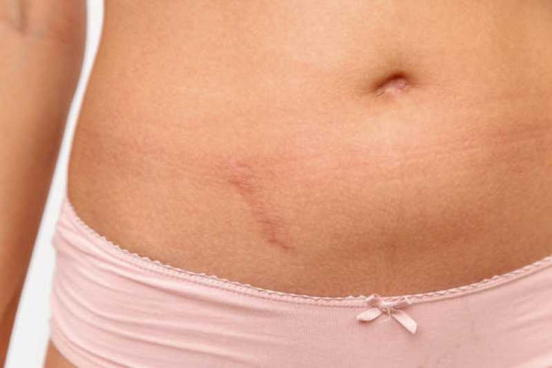 Clínica Que Faz Correção Reparadora de Cicatriz Residencial Morada Lagos - Correção de Cicatriz de Abdominoplastia