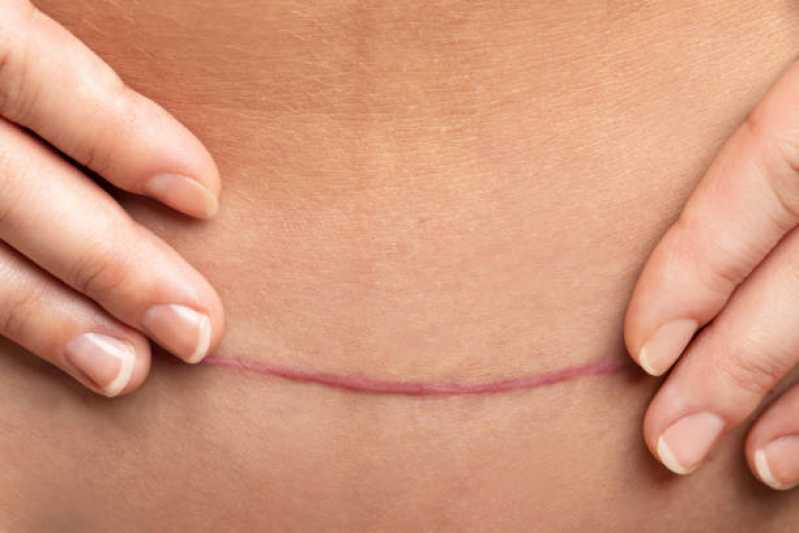 Correção Cicatriz Clínica Novo Osasco - Correção de Cicatriz Abdominoplastia