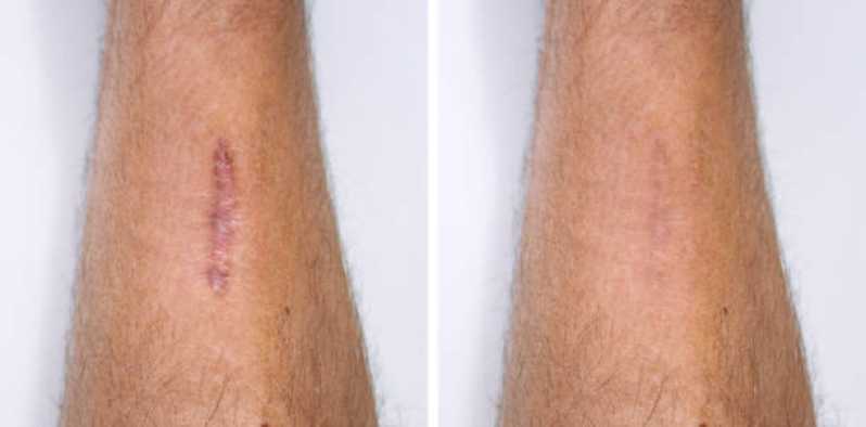 Correção de Cicatriz Abdominoplastia Agendar Vila Sol - Correção de Cicatriz no Rosto