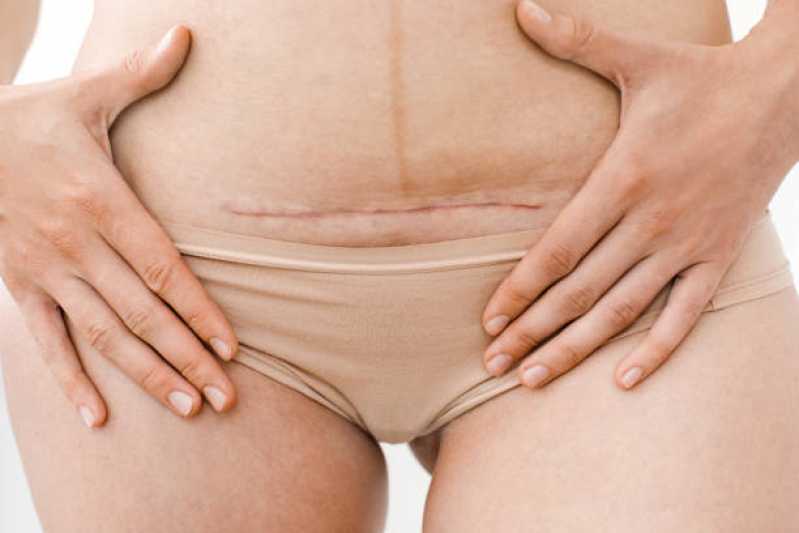 Correção de Cicatriz de Abdominoplastia Agendar Vila Sul Americana - Correção de Cicatriz Mamoplastia