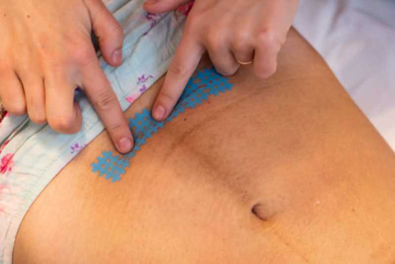 Correção de Cicatriz de Cesárea Agendar Itapevi - Correção de Cicatriz Mamoplastia
