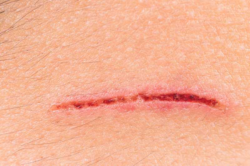 Correção de Cicatriz de Mama Jardim Celeste - Correção de Cicatriz de Cirurgia Plástica