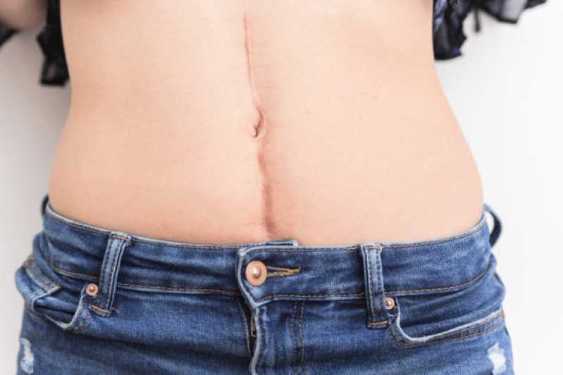 Correção de Cicatriz Mamoplastia Agendar Vila Freitas - Correção de Cicatriz Abdominoplastia