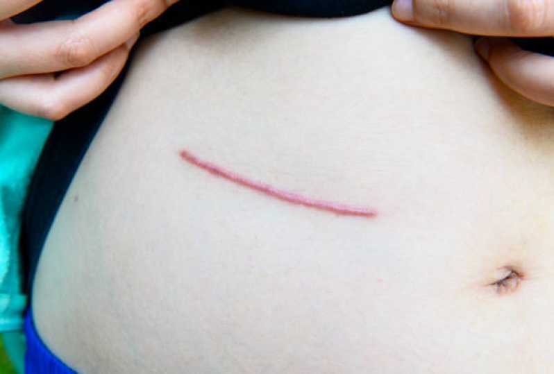 Correção de Cicatriz Mamoplastia Vila Rosa - Correção de Cicatriz Abdominoplastia