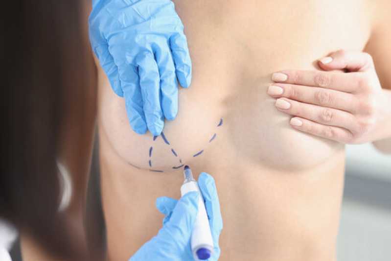 Mamoplastia Redutora e Abdominoplastia Recantinho - Mamoplastia Redutora sem Silicone