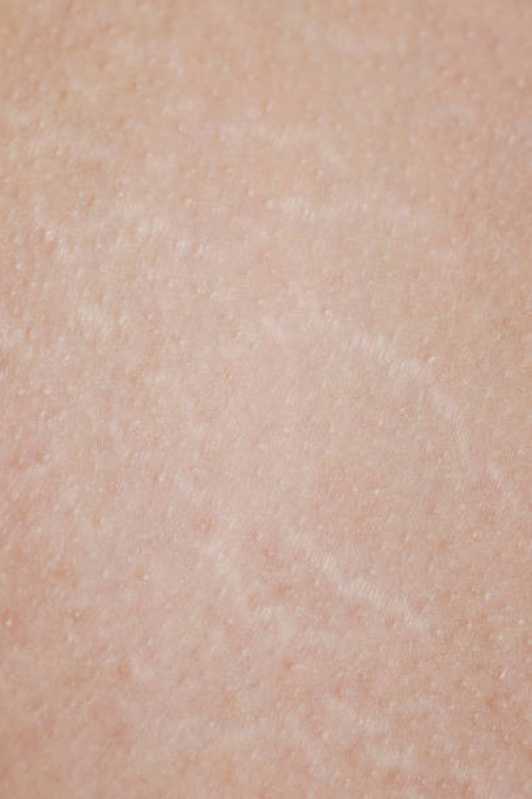 Microagulhamento para Poros Dilatados Agendar Vila Creti - Microagulhamento para Acne
