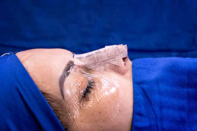 Onde Fazer Cirurgia para Diminuir o Nariz Vilarejo - Cirurgia de Rinoplastia Reparadora