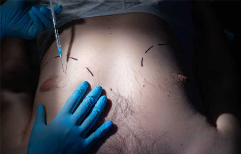 Onde Fazer Cirurgia para Ginecomastia Chácara Adriana Aparecida - Cirurgia de Ginecomastia Bilateral Masculina