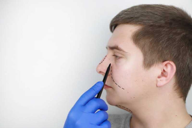Onde Fazer Cirurgia Rinoseptoplastia Vila Menk - Cirurgia para Correção da Estética Nasal