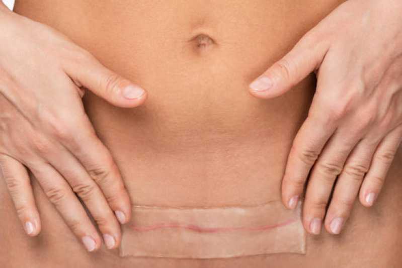Onde Fazer Correção Cicatriz Abdominoplastia Veloso - Correção de Cicatriz Mamoplastia