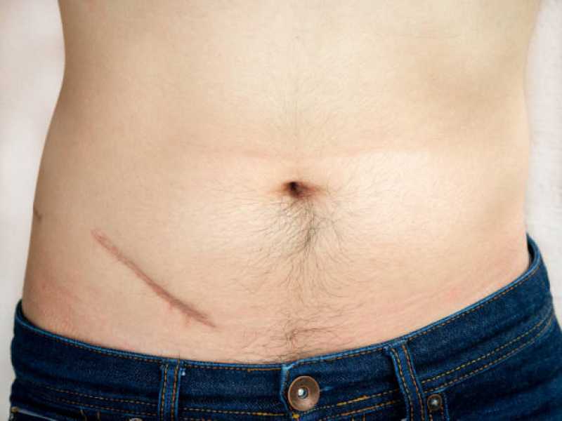 Onde Fazer Correção de Cicatriz de Abdominoplastia Bandeiras - Correção de Cicatriz Mamoplastia