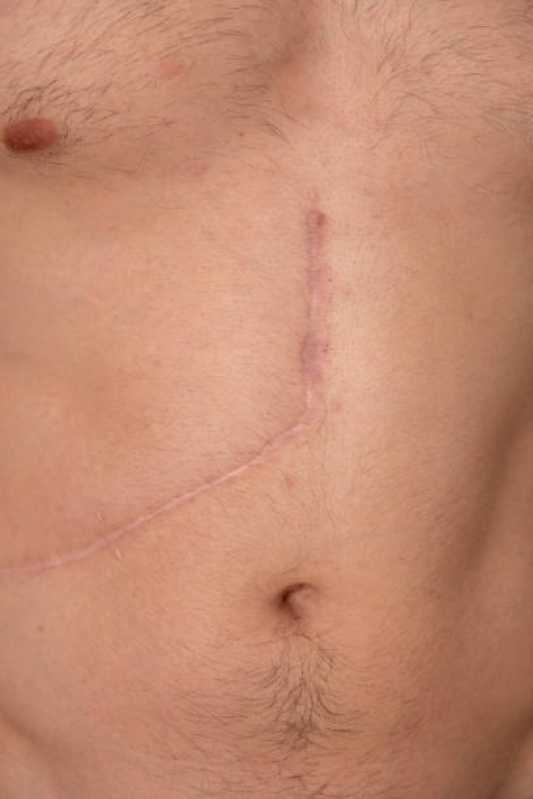 Onde Fazer Correção de Cicatriz de Cesárea Bandeiras - Correção de Cicatriz de Cirurgia Plástica