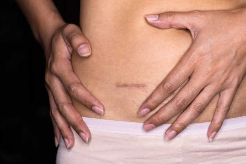Onde Fazer Correção de Cicatriz Mamoplastia Jardim Iracema - Correção de Cicatriz Mamoplastia