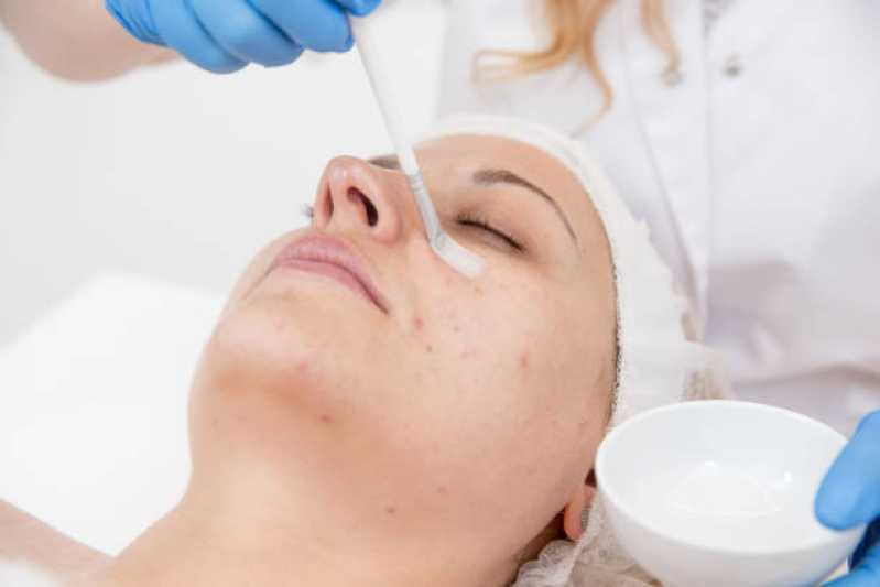 Onde Tem Peeling Facial de Diamante Profissional Vila Cristina - Peeling Facial Químico
