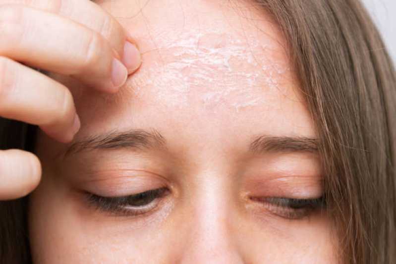 Peeling Facial de Diamante Clínica Quatro Encruzilhadas - Peeling Facial Químico