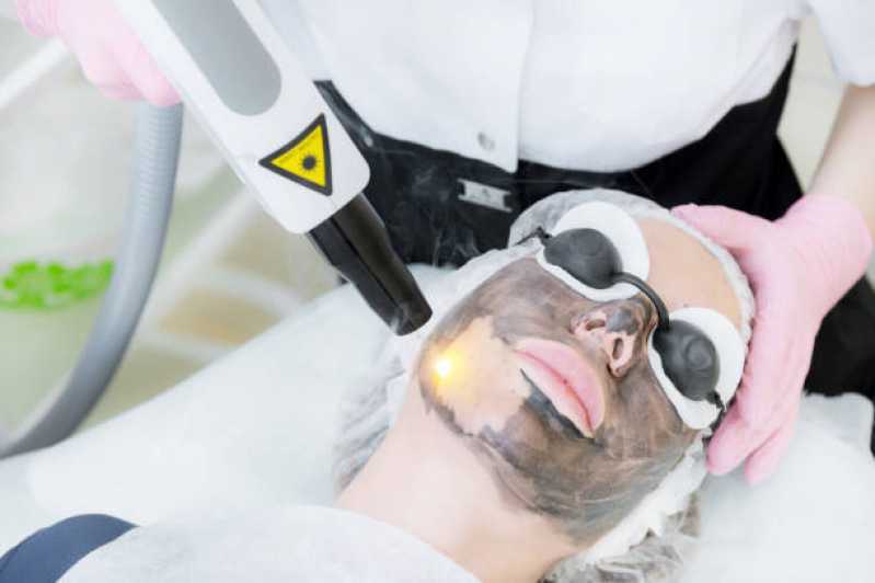 Peeling Facial de Diamante Profissional Clínica Conjunto Habitacional - Setor B - Peeling Facial Químico