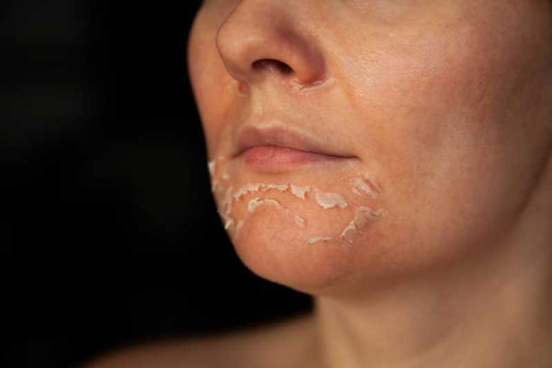Peeling Facial Limpeza de Pele Clínica Terras do Madeira - Peeling Facial Químico