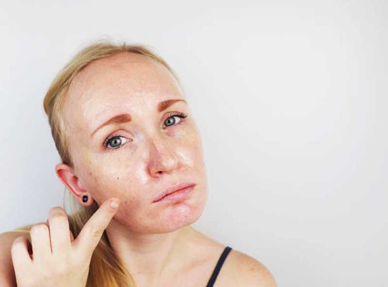 Peeling para Rosto Clínica Vila Menk - Peeling Facial Químico