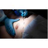 Cirurgia de Ginecomastia para Homens