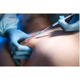 cirurgia de ginecomastia para homens Conjunto Habitacional - Setor D