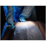 cirurgia para ginecomastia Vila Menck