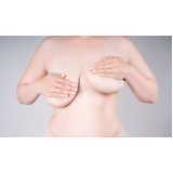 clínica especializada em mamoplastia redução Vila Universal